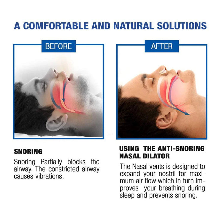 Anti-Snoring Nose Vents Set – Nasal Dilators for Better Sleep